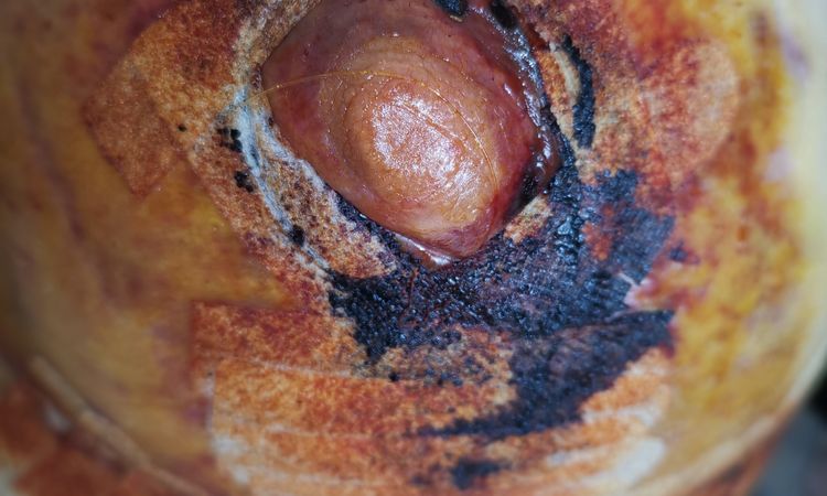 Posible necrosis de areola tras mastopexia - 83988
