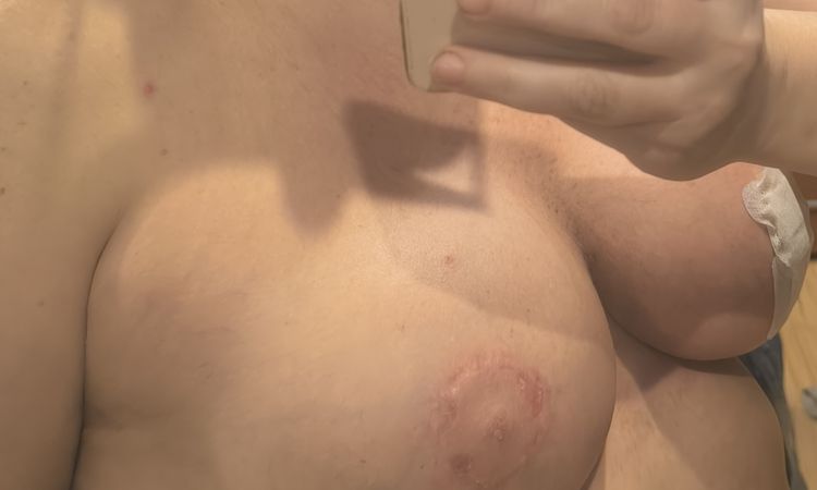 Desilusionada con maxtopexia - 84077