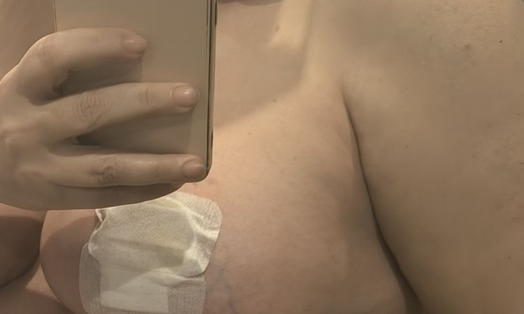 Desilusionada con maxtopexia - 84078