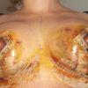 Inflamación y hematoma tras mastopexia con aumento