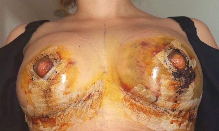 Inflamación y hematoma tras mastopexia con aumento - 84082