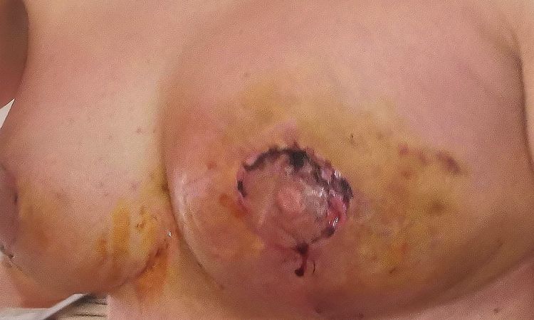 Inflamación y hematoma tras mastopexia con aumento - 84083