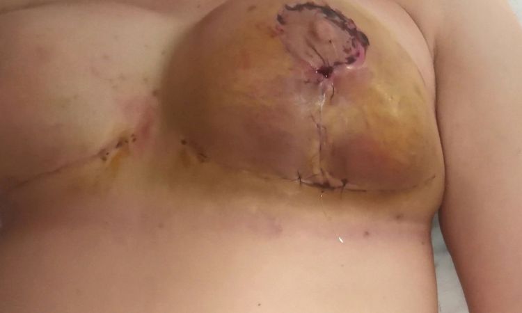 Inflamación y hematoma tras mastopexia con aumento - 84084
