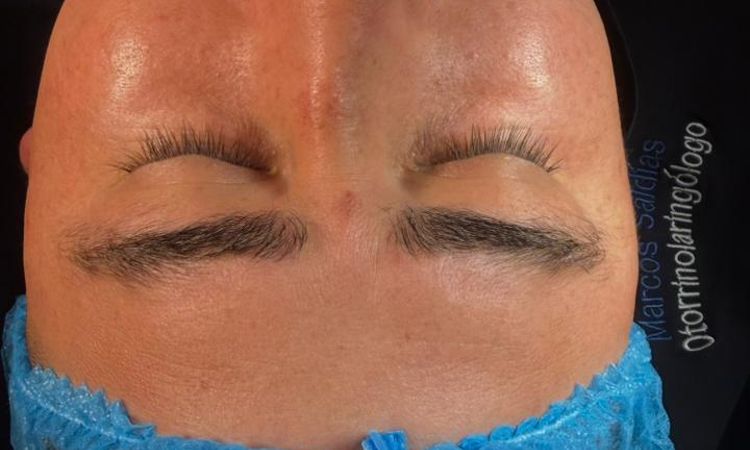 Puede volver a desviarse la nariz tras una rinoseptoplastia sin injerto? - 84152