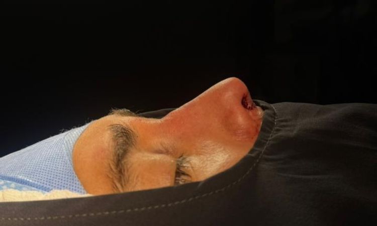 Puede volver a desviarse la nariz tras una rinoseptoplastia sin injerto? - 84153