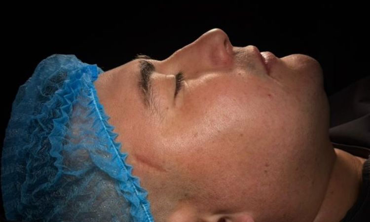 Puede volver a desviarse la nariz tras una rinoseptoplastia sin injerto? - 84154