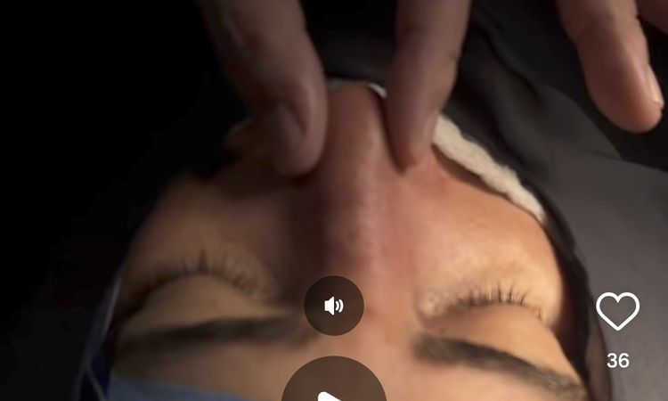 Puede volver a desviarse la nariz tras una rinoseptoplastia sin injerto? - 84155