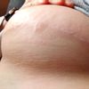 Inflamación reducción de pecho un año des