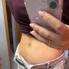 Ombligo plano tras abdominoplastia