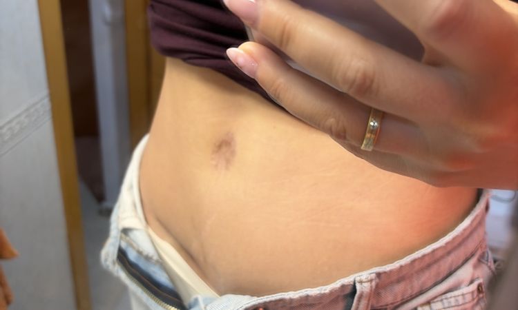 Ombligo plano tras abdominoplastia - 84354