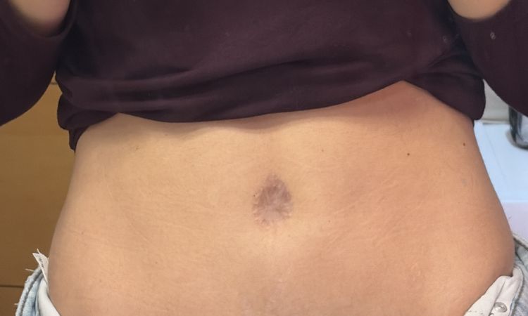 Ombligo plano tras abdominoplastia - 84355