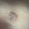 Ombligo plano tras abdominoplastia