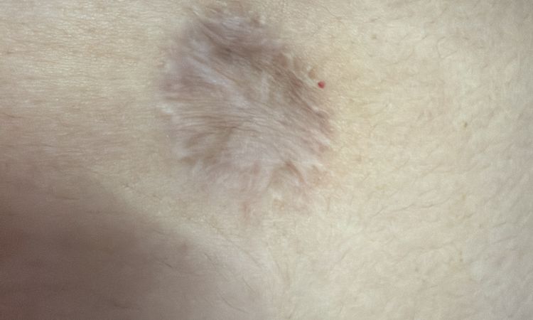 Ombligo plano tras abdominoplastia - 84356