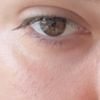 inflamación/fibrosis por radio frecuencia encima de ácido hialuronico