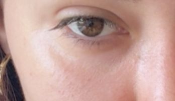 inflamación/fibrosis por radio frecuencia encima de ácido hialuronico - 84423