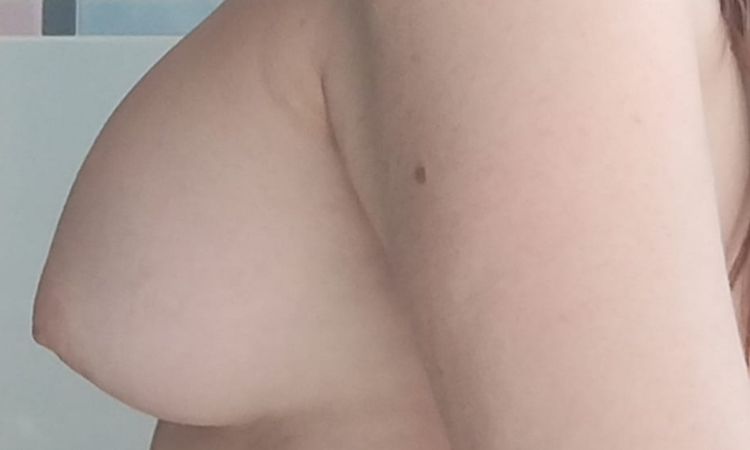 Matopexia periareolar o vertical corta??? - 84436
