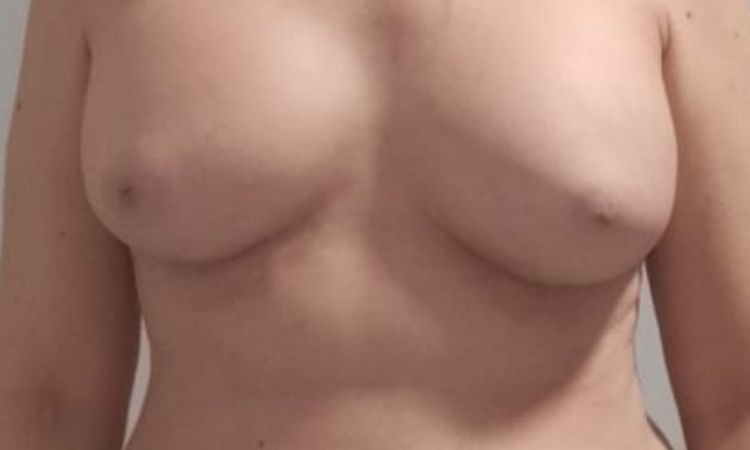 Matopexia periareolar o vertical corta??? - 84437