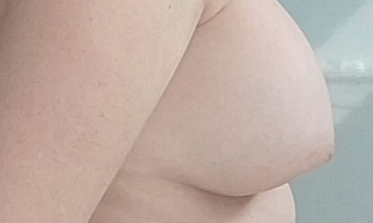Matopexia periareolar o vertical corta??? - 84439