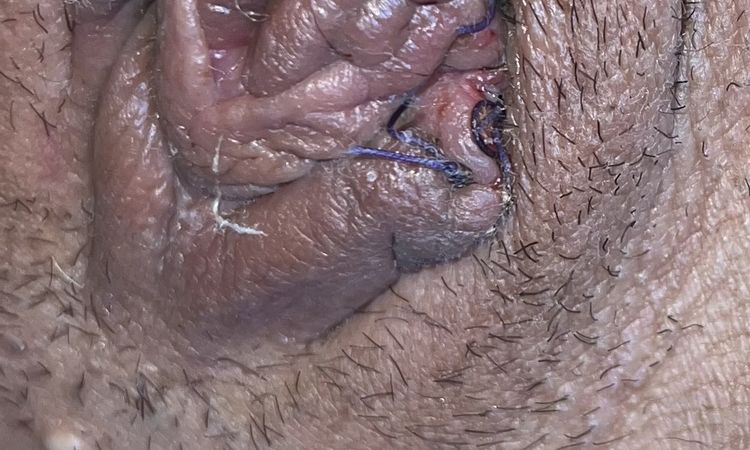Labioplastia preocupación cicatrización - 84546