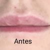 El aumento de labios fallido