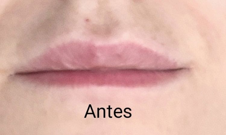 El aumento de labios fallido - 84591