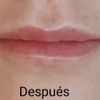 El aumento de labios fallido