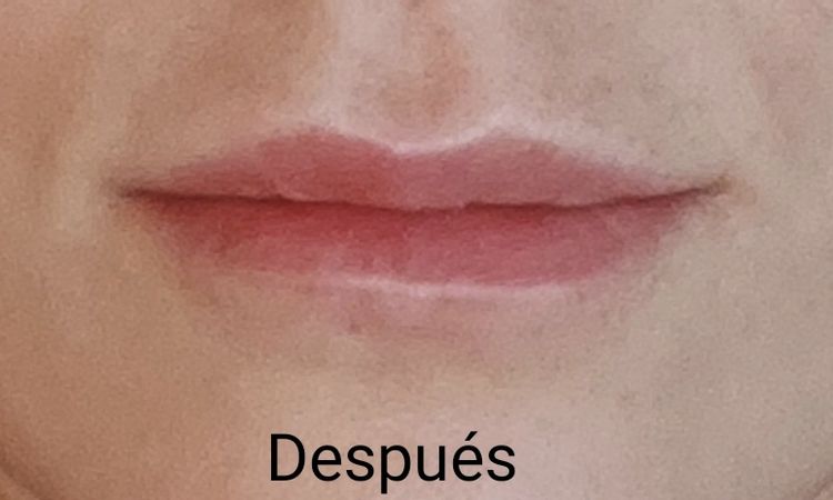 El aumento de labios fallido - 84592