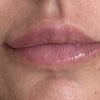 Asimetria en labios despues del acido hialuronico