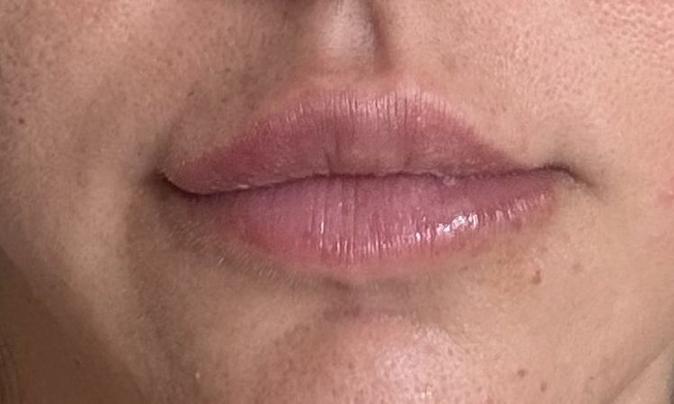 Asimetria en labios despues del acido hialuronico - 84739