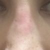 Tabique rojo tras rinoplastia secundaria con injerto costal