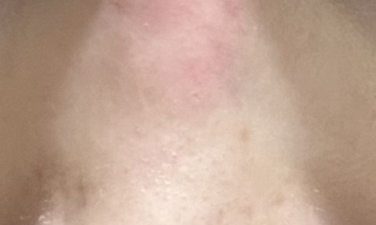Tabique rojo tras rinoplastia secundaria con injerto costal - 84800