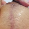 Herida tras caída de costra en la T invertida