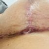 Herida tras caída de costra en la T invertida