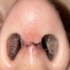 Quiero ver si mi cicatrización  de la rinoplastia es normal