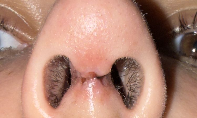 Quiero ver si mi cicatrización  de la rinoplastia es normal - 84844