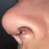 Quiero ver si mi cicatrización  de la rinoplastia es normal