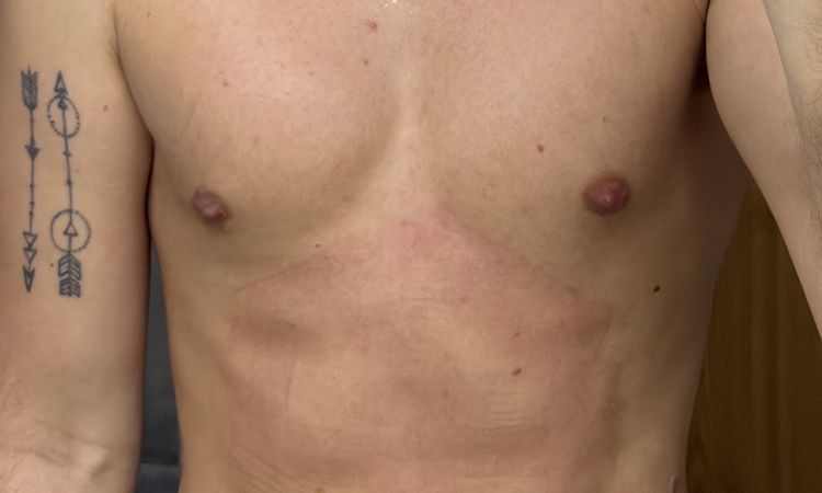 No veo resultados 5 semanas de mi marcacion abdominal con vaser renuvion - 84848