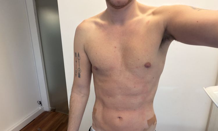No veo resultados 5 semanas de mi marcacion abdominal con vaser renuvion - 84849