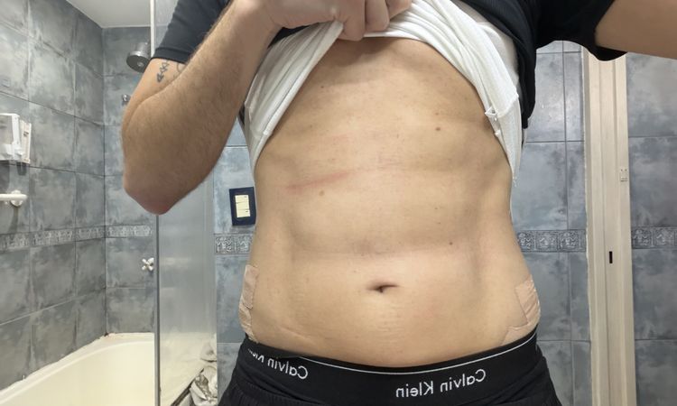 No veo resultados 5 semanas de mi marcacion abdominal con vaser renuvion - 84850