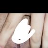 Amputación labios menores