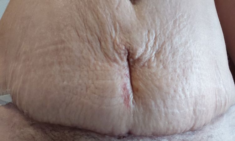 Reaparición de arrugas tras retirar la faja de abdominoplastia - 85013