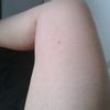 ¿La carboxterapia me puede ayudar?