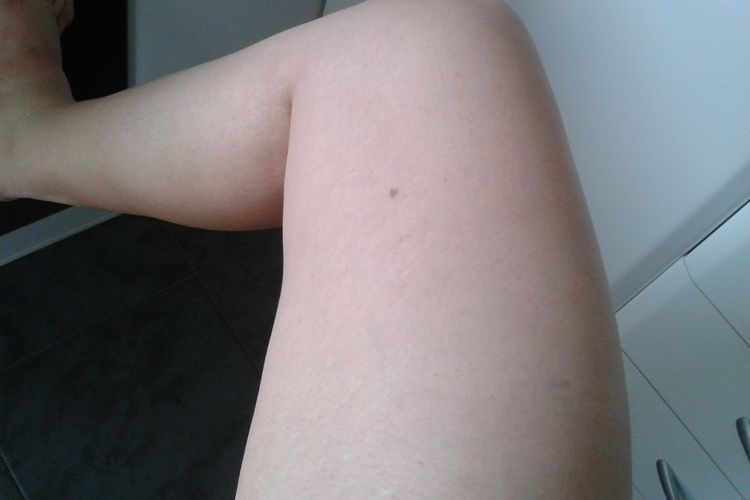 ¿La carboxterapia me puede ayudar?