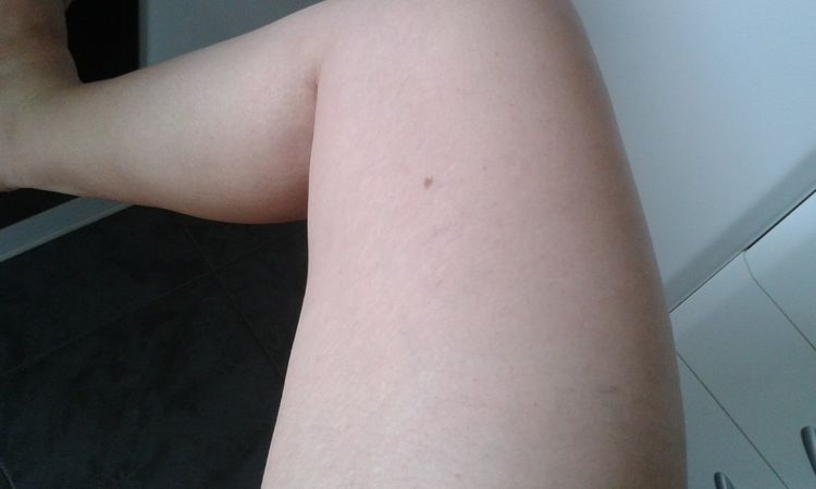 ¿La carboxterapia me puede ayudar? - 295