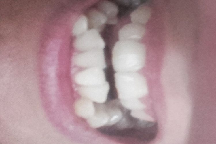 cuanto tiempo hay q usar brackets