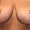 Hace 2 años me hice una mamoplastia reducción¿se puede reconstruir el pecho?