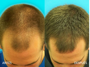 donante tratamiento capilar