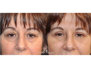 Antes y después de una blefaroplastia