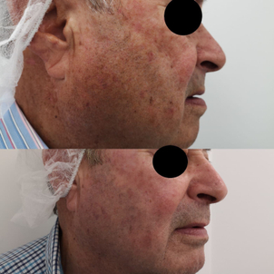 antes y después tratamiento antimanchas