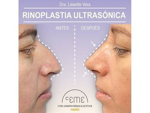 antes y después rinomodelación